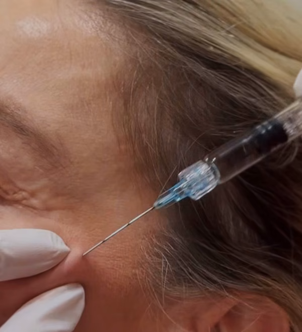Skin Boosters Treatment