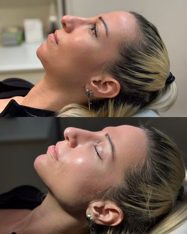 Face Contour Treatment
