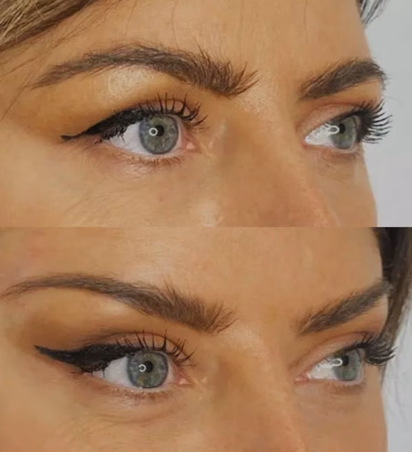 Fox Eyes Treatment