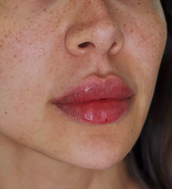 Lips Treatment