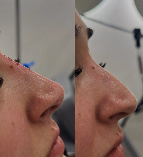 Liquid Rhino Treatment